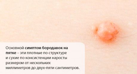 الثؤلول في الكعب: ماذا تفعل؟