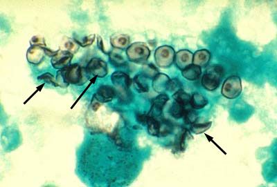 العامل المسبب لمرض داء المتكيسات الرئوية (Pneumocystis jiroveci)