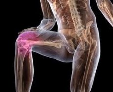 Osteoartroza unguentului genunchiului
