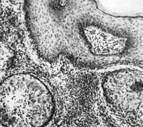 مسببات الأمراض chromoblastomycosis